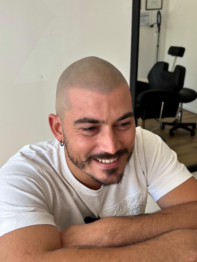 tricopigmenation cicatrisée studio smp